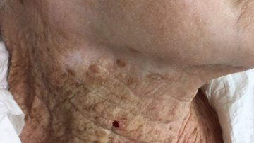 Foto que se espalhou pelas redes sociais nos últimos dias mostra a diferença da pele de uma senhora entre o rosto, onde usou protetor solar no rosto por muitos anos, e o pescoço. - Foto: JEADV (Journal of the European Academy of Dermatology and Venereology)
